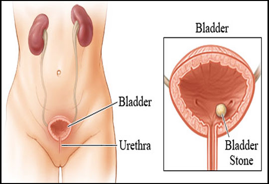 Bladder Stones