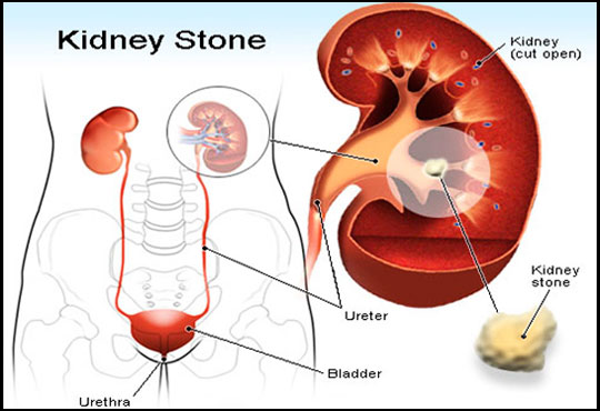 Kidney Stones