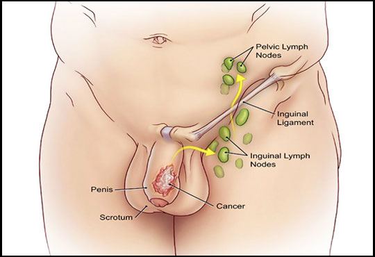 Penile Cancer