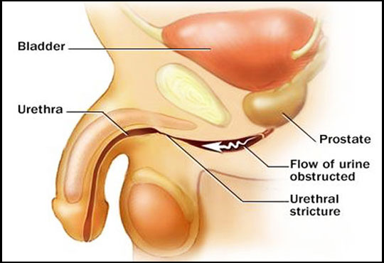 Stricture Uretlfra