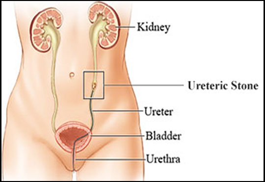 Ureteric Stones