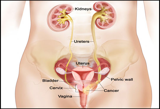 Cervical Cancer